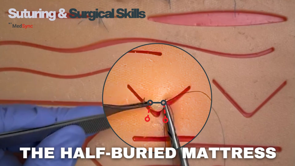 Half-buried mattress suture